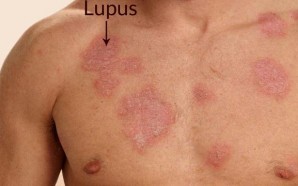 12 Early Symptoms and Signs You Have Lupus