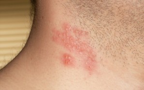 What You Should Know About Shingles