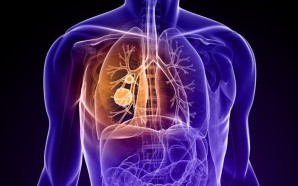 Lung Cancer Survival Rates And Life Expectancy