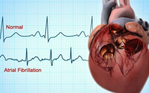 Your Ultimate Guide to Atrial Fibrillation