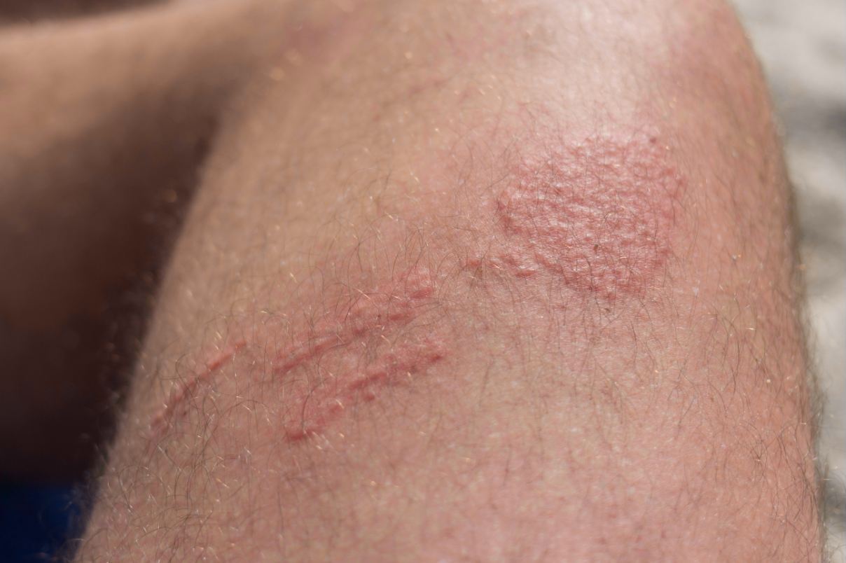 Skin Rash Diagnosis: Atopic Dermatitis(Eczema )or Psoriasis?